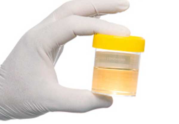 Esami chimico fisici delle urine